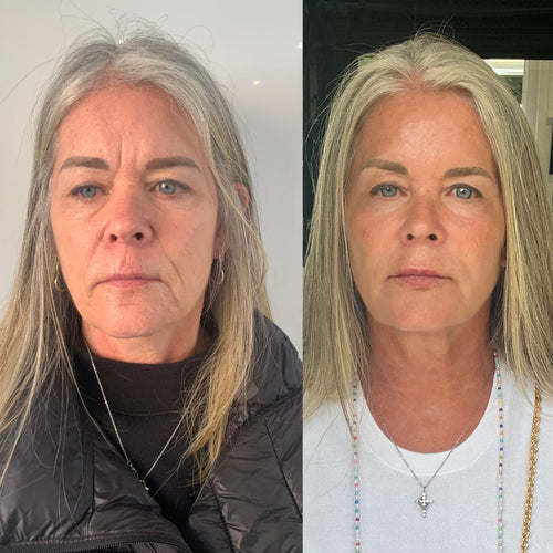 COMBINATION: Complete GLOWverhaul & Neck Rejuvenation