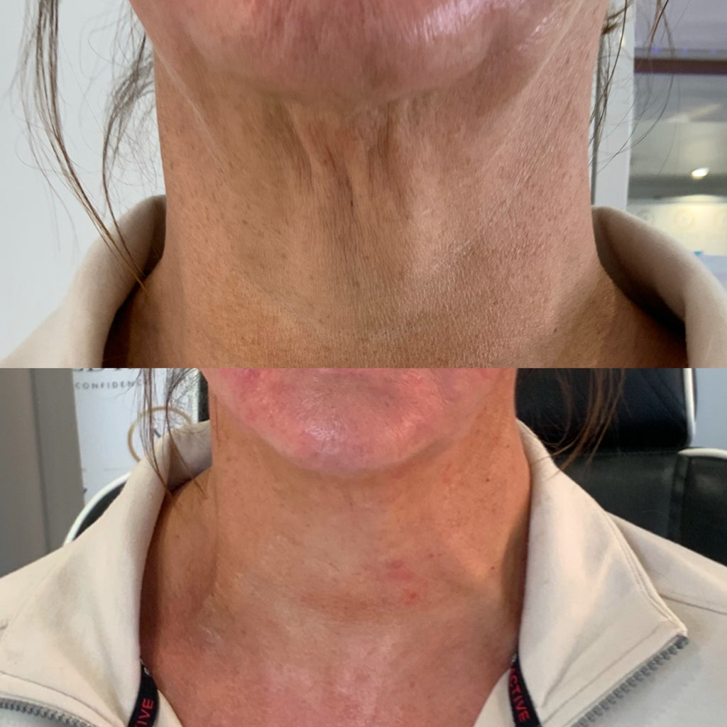NECK REJUVENATION
