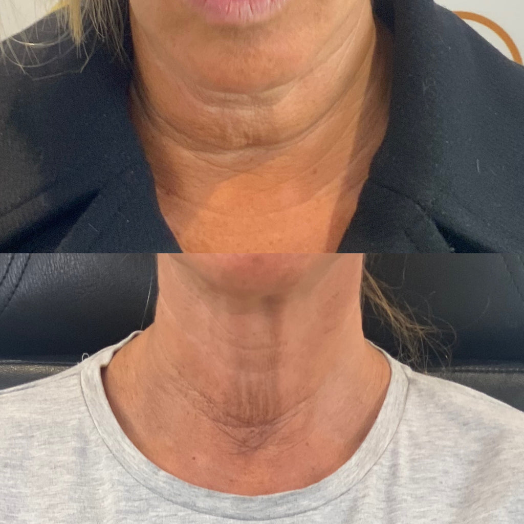 NECK REJUVENATION