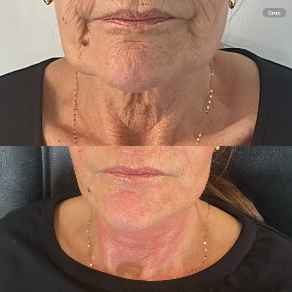NECK REJUVENATION